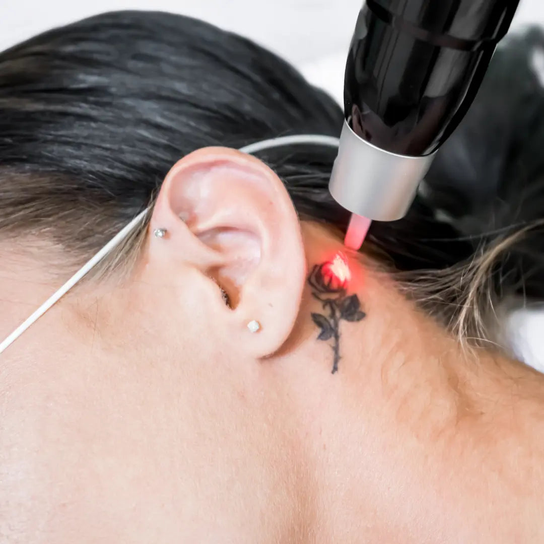 TATTOO FADEAWAY-MEDIUM (PACKAGE OF 6) ColoradoBeautyRN