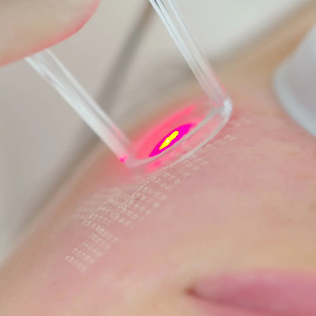 ULTIMATE RESURFACING LASER- BUY ONE GET ONE ColoradoBeautyRN