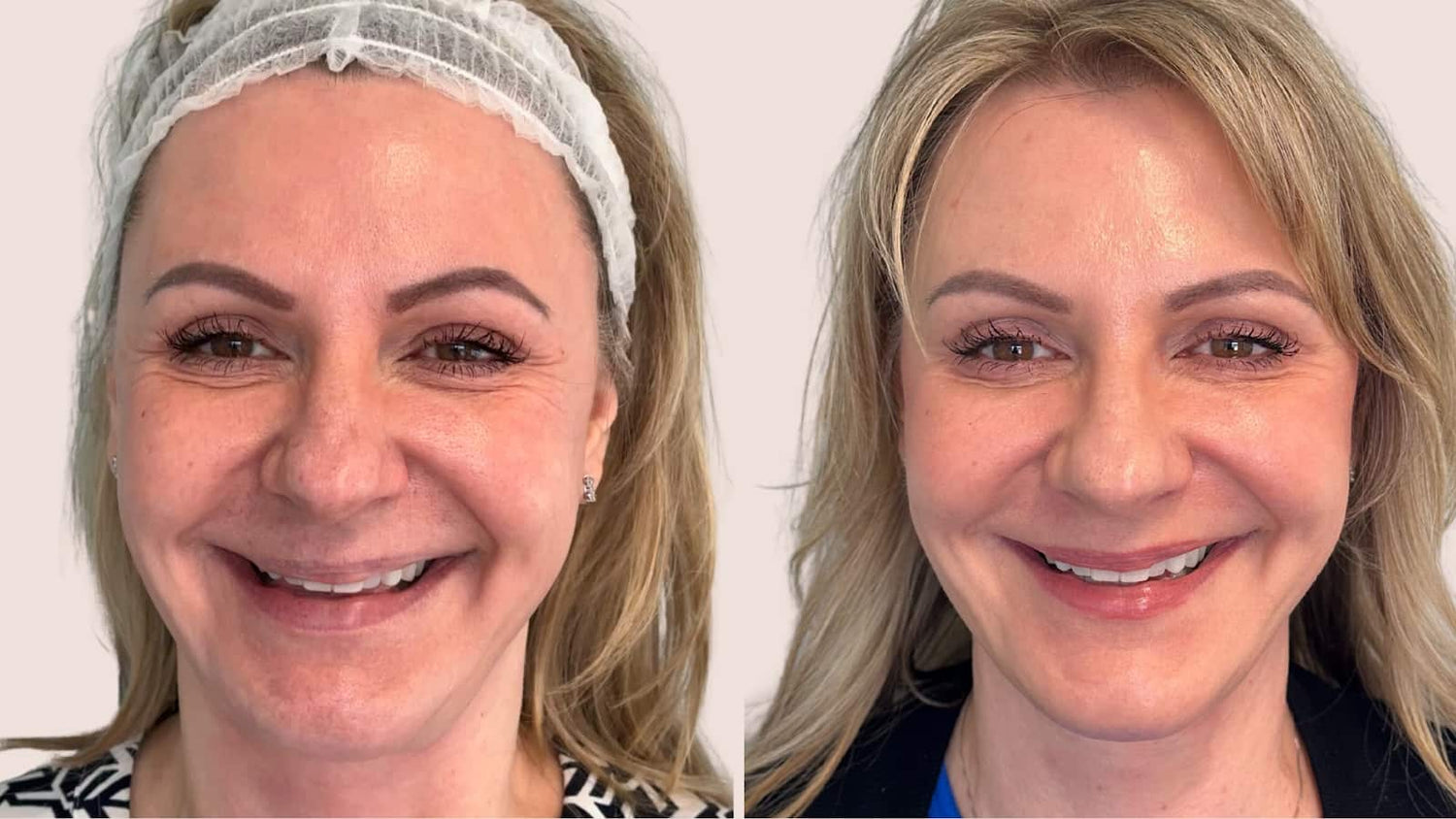 Botox & Jeuveau Transformation