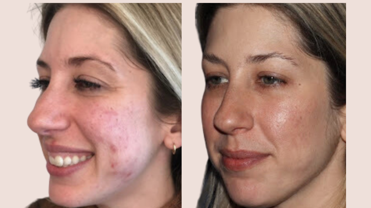 Chemical Peel Transformation
