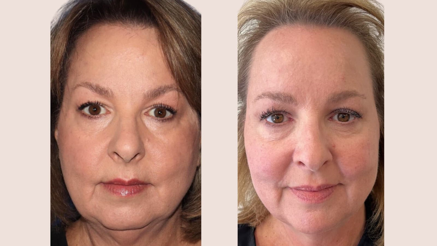 before and after under eye filler enhancement