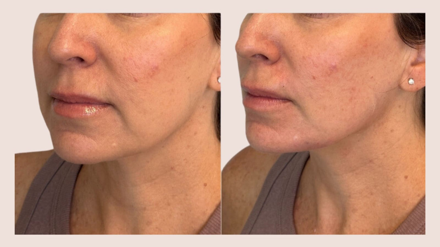 before and after chin shadow treatment