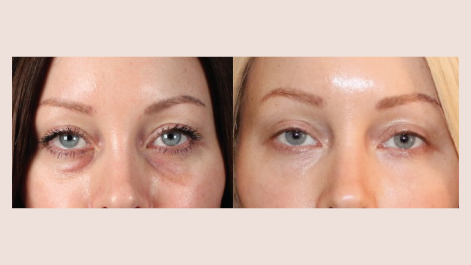 before and after PRP/PRF under eye injections enhancement