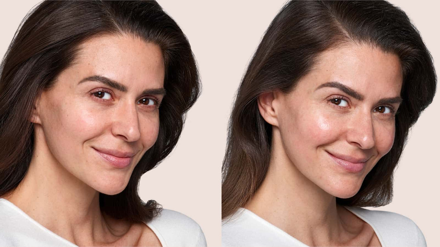 before and after skinvive - injectable hydration transformation