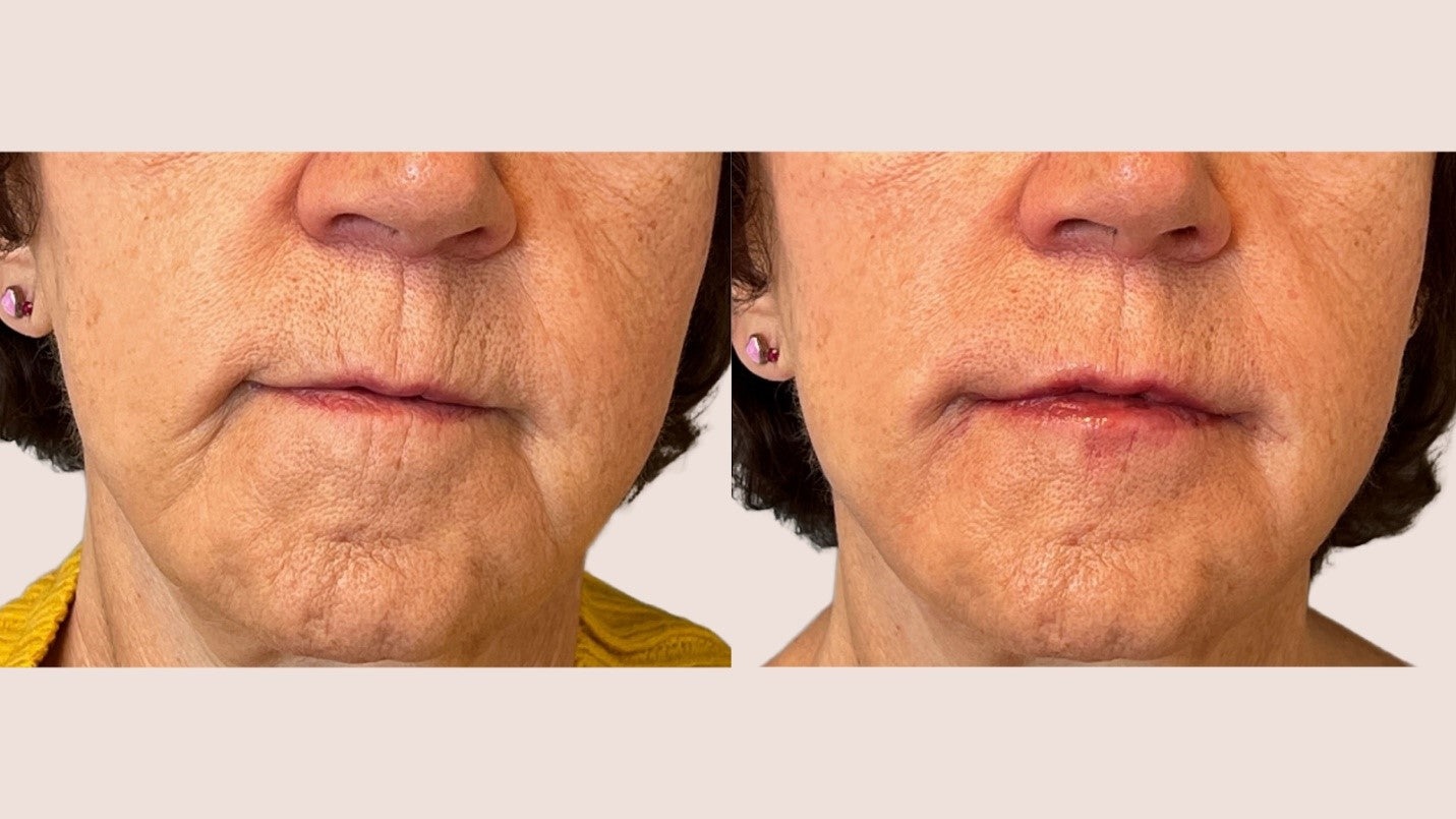 upper lip line softening: before & after with subcision