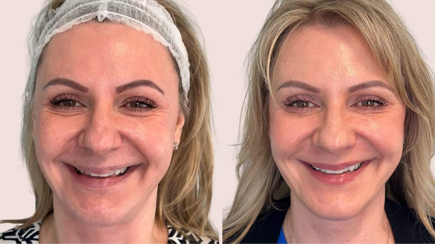  Botox & Jeuveau Transformation