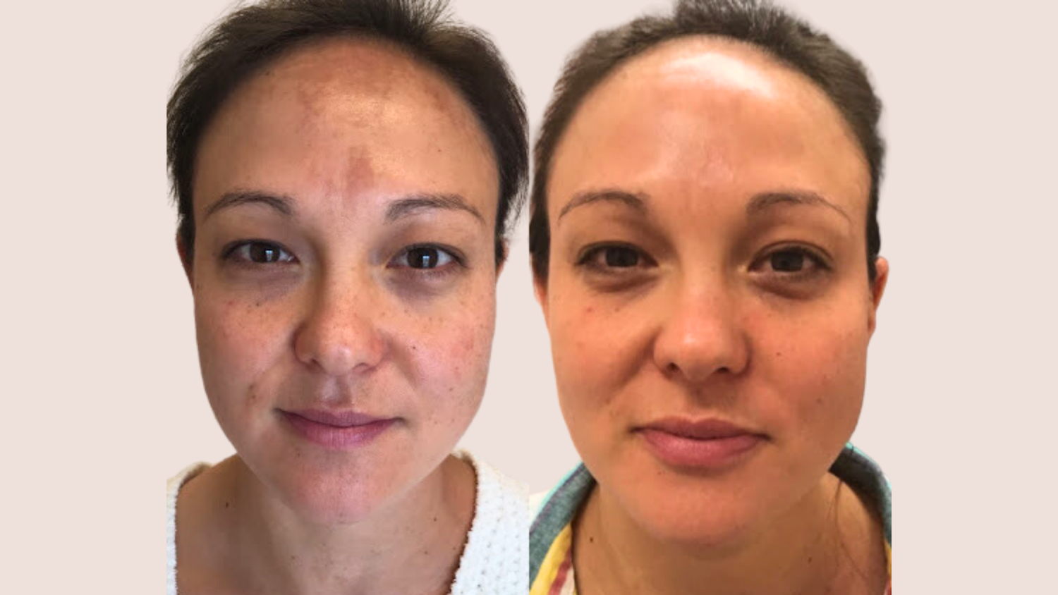 Before & After Peel Results
