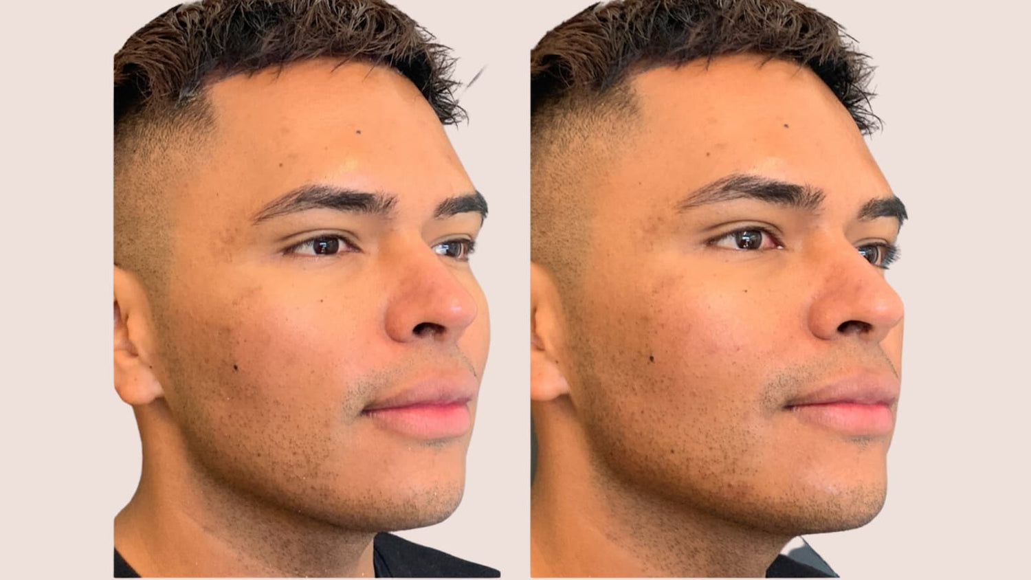 Jawline and Chin Filler Transformation