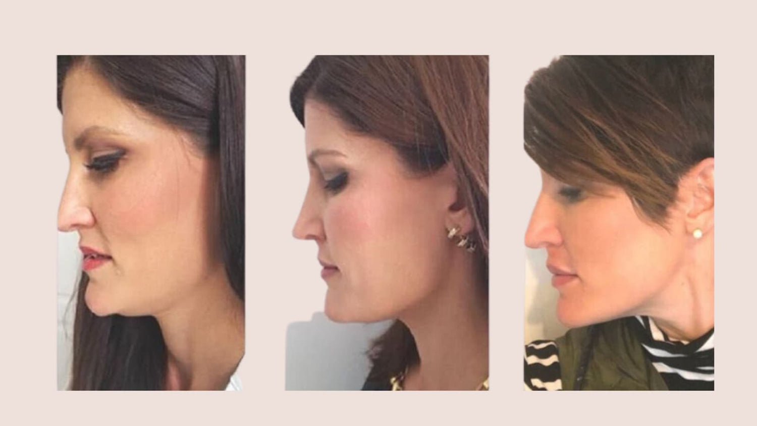 person's profile before & after kybella
