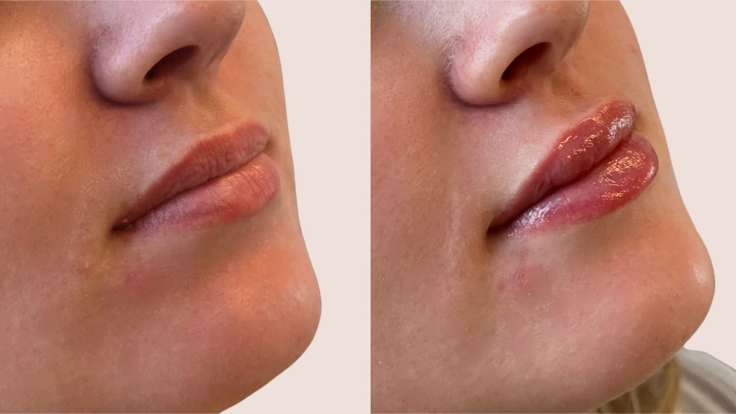 lips after filler treatment