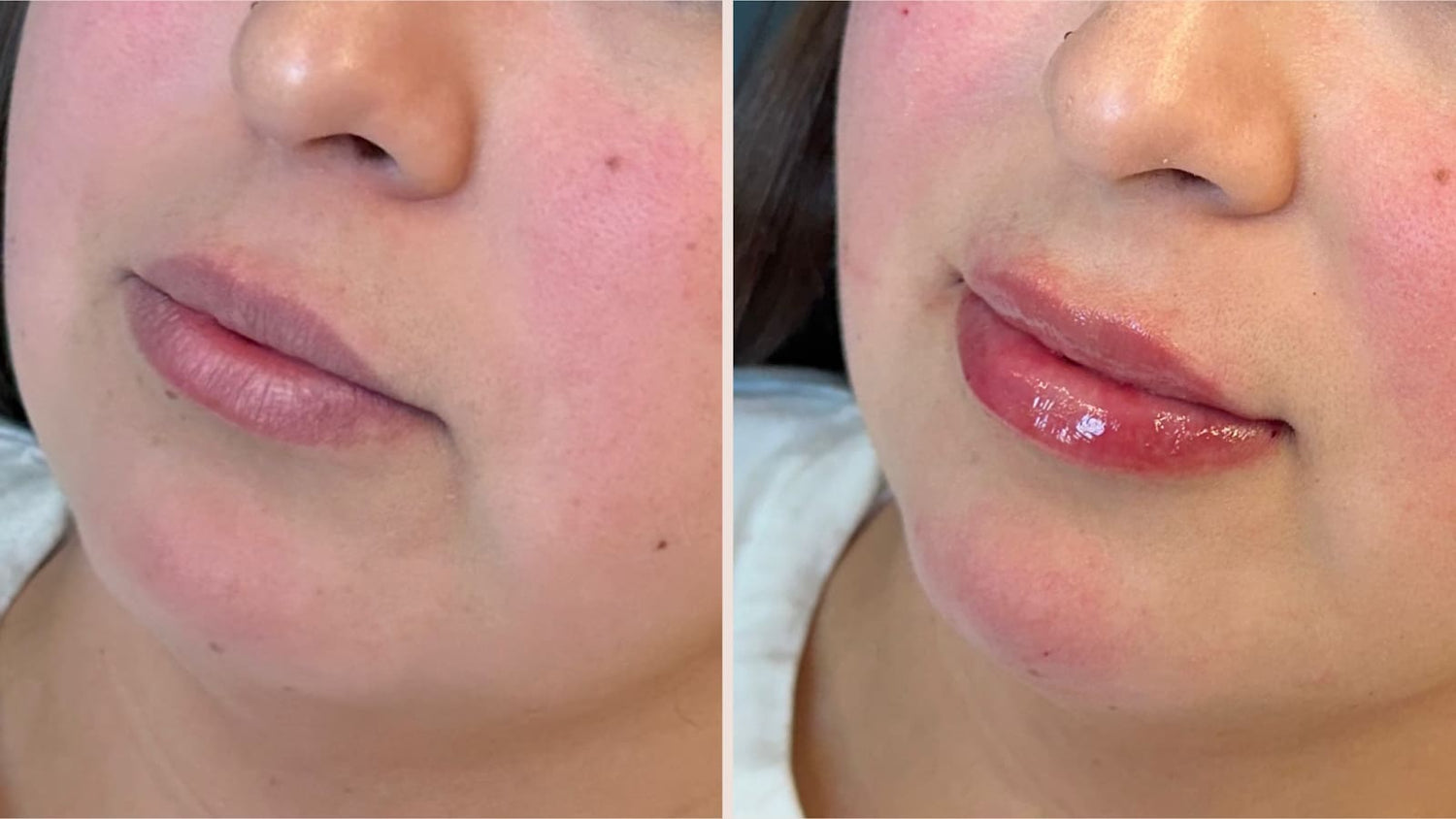 enhanced lips after filler treatment