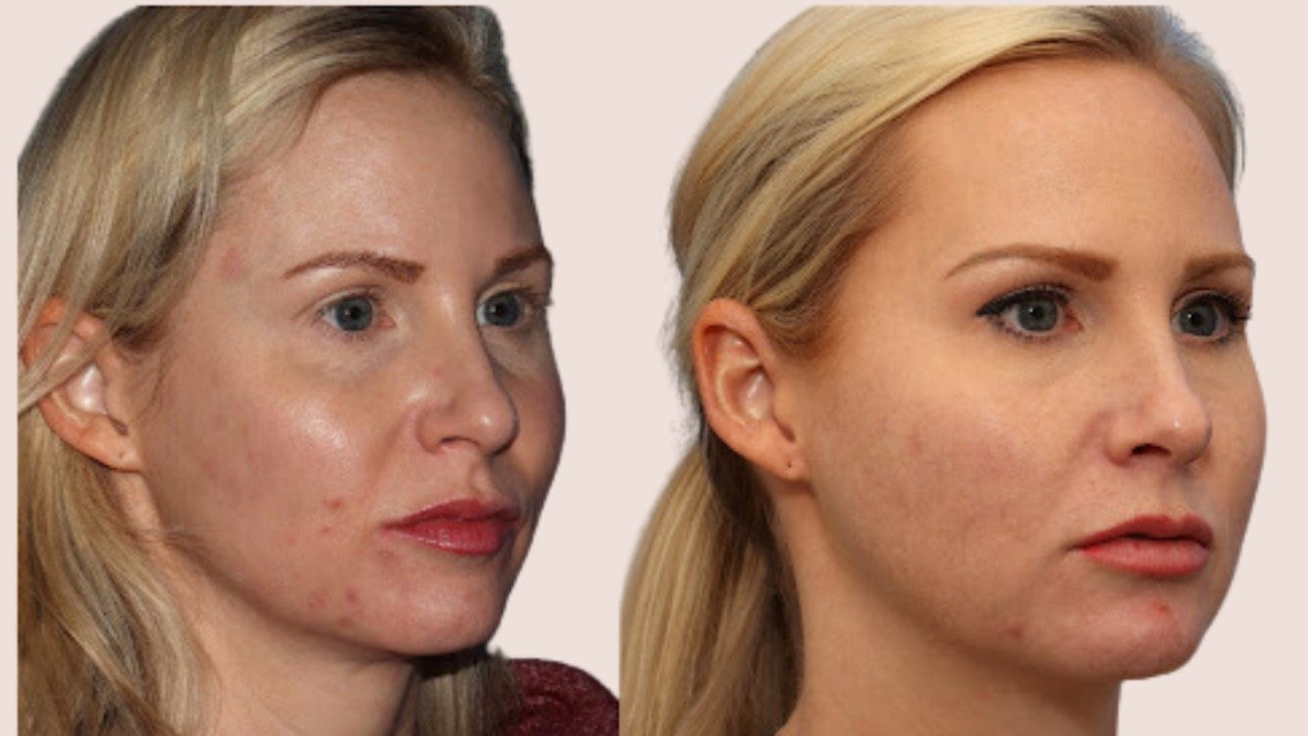 before and after microneedling treatment
