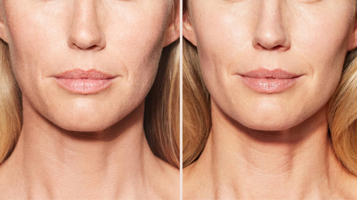 A before-and-after picture after Sculptra treatment
