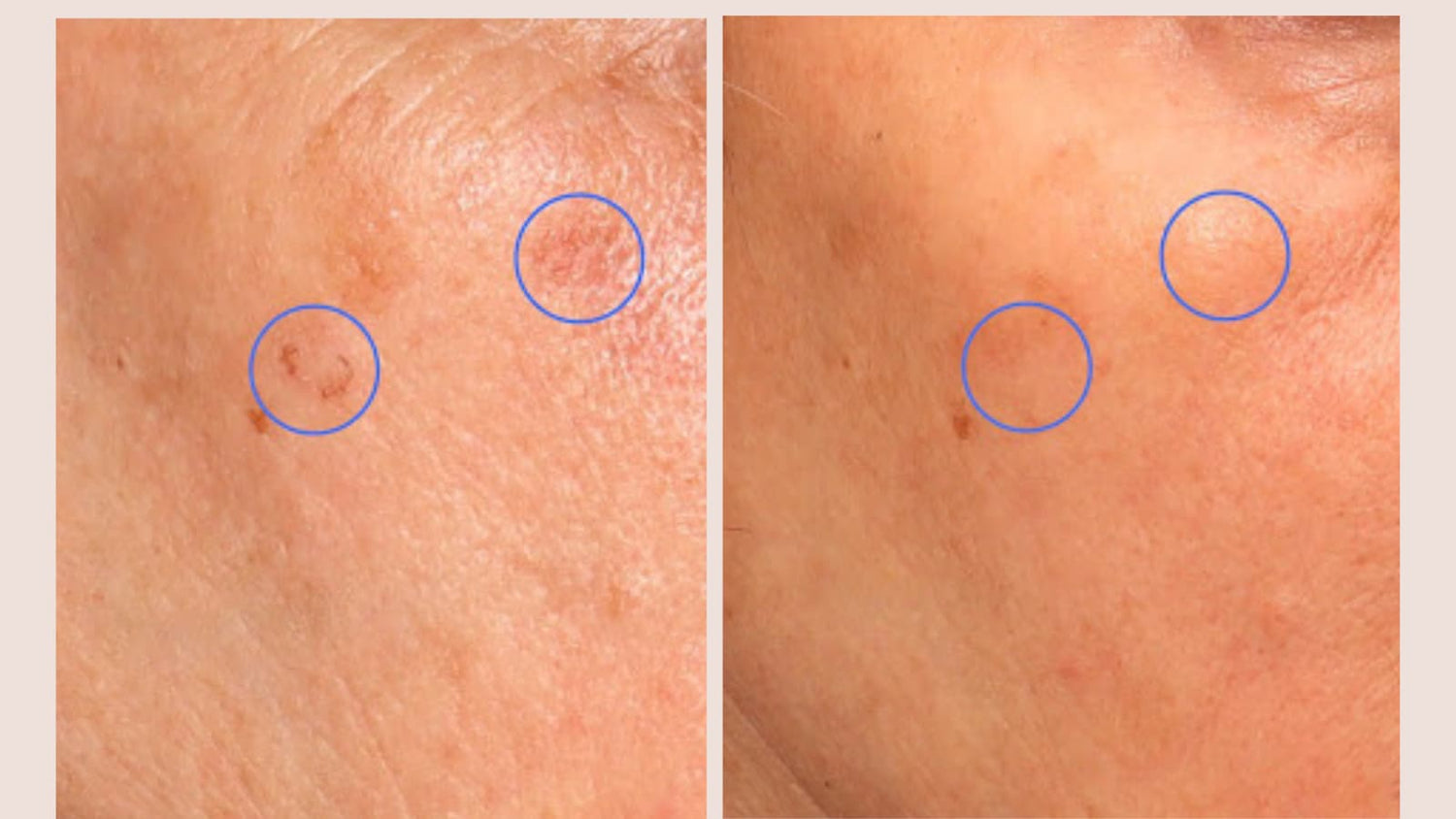 skin classic treatment results